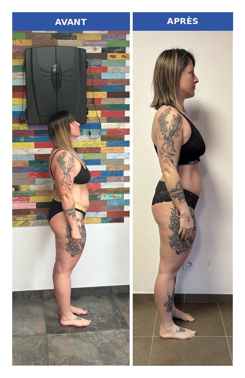 Camille — SOPK, 12 mois de suivi, perte de 10 kg